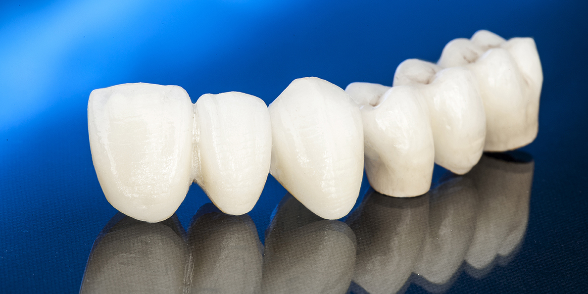 Металлокерамический мостовидный протез зубов