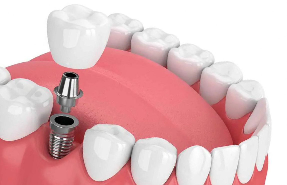 Имплант одного зуба